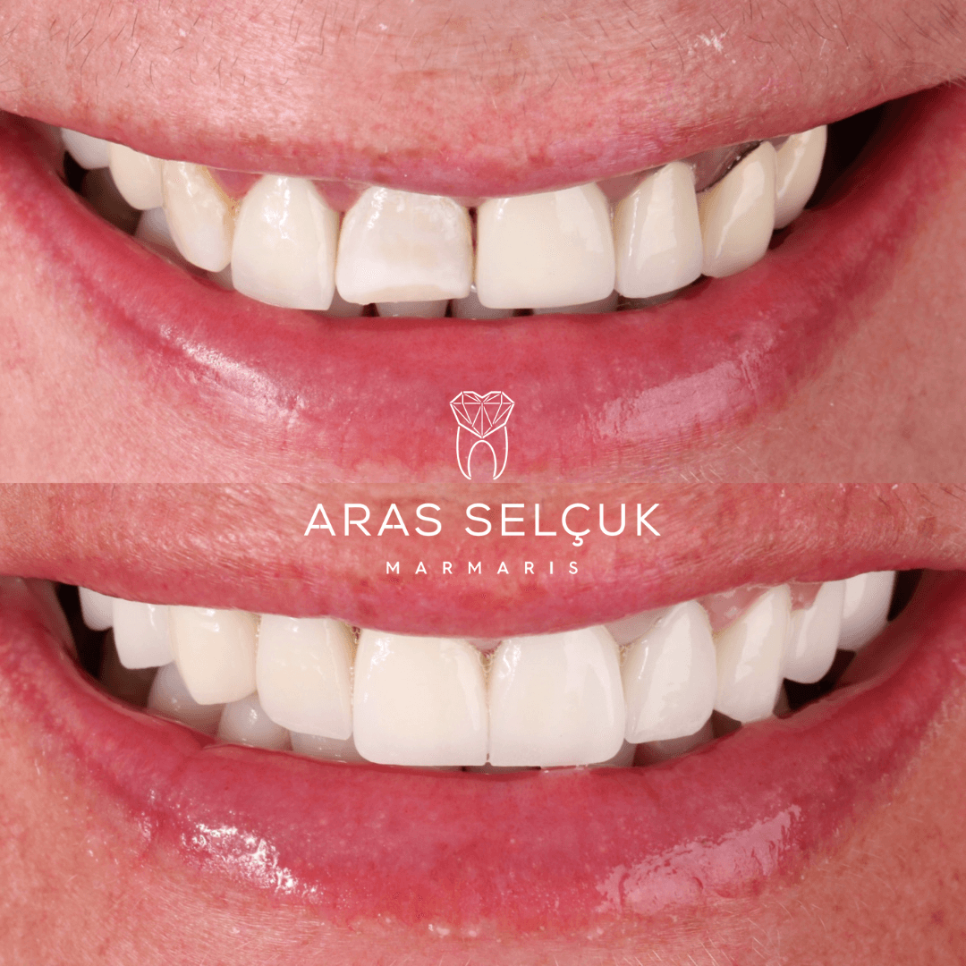 aeshetic zirconium crown 