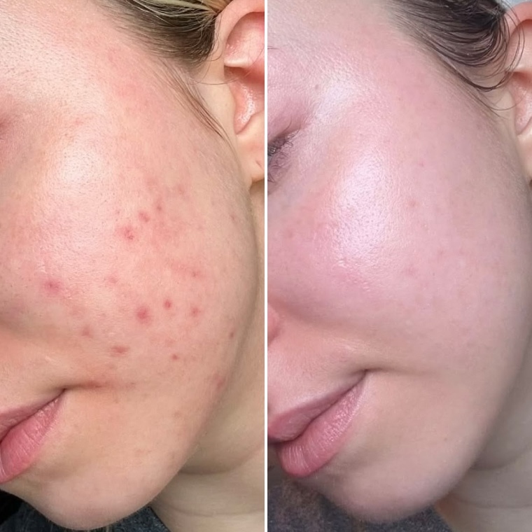 до та після — Катерина, 31