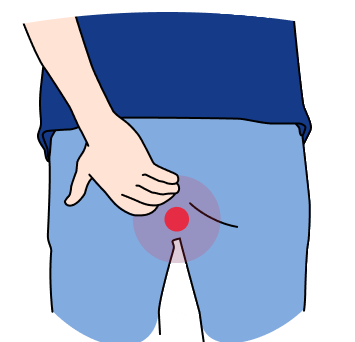 обострение геморроя