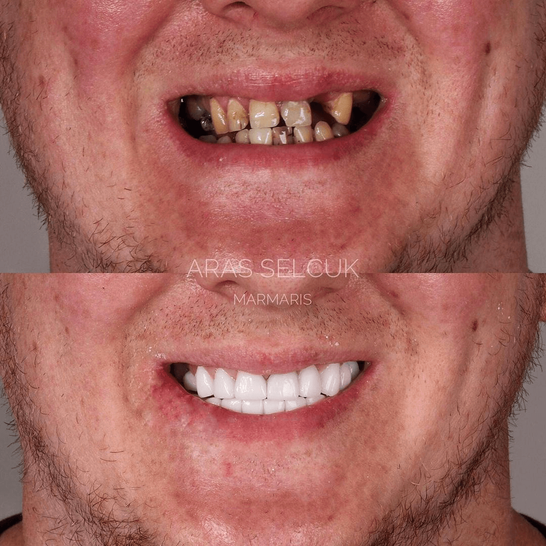 Best Dental Treatment in Turkey