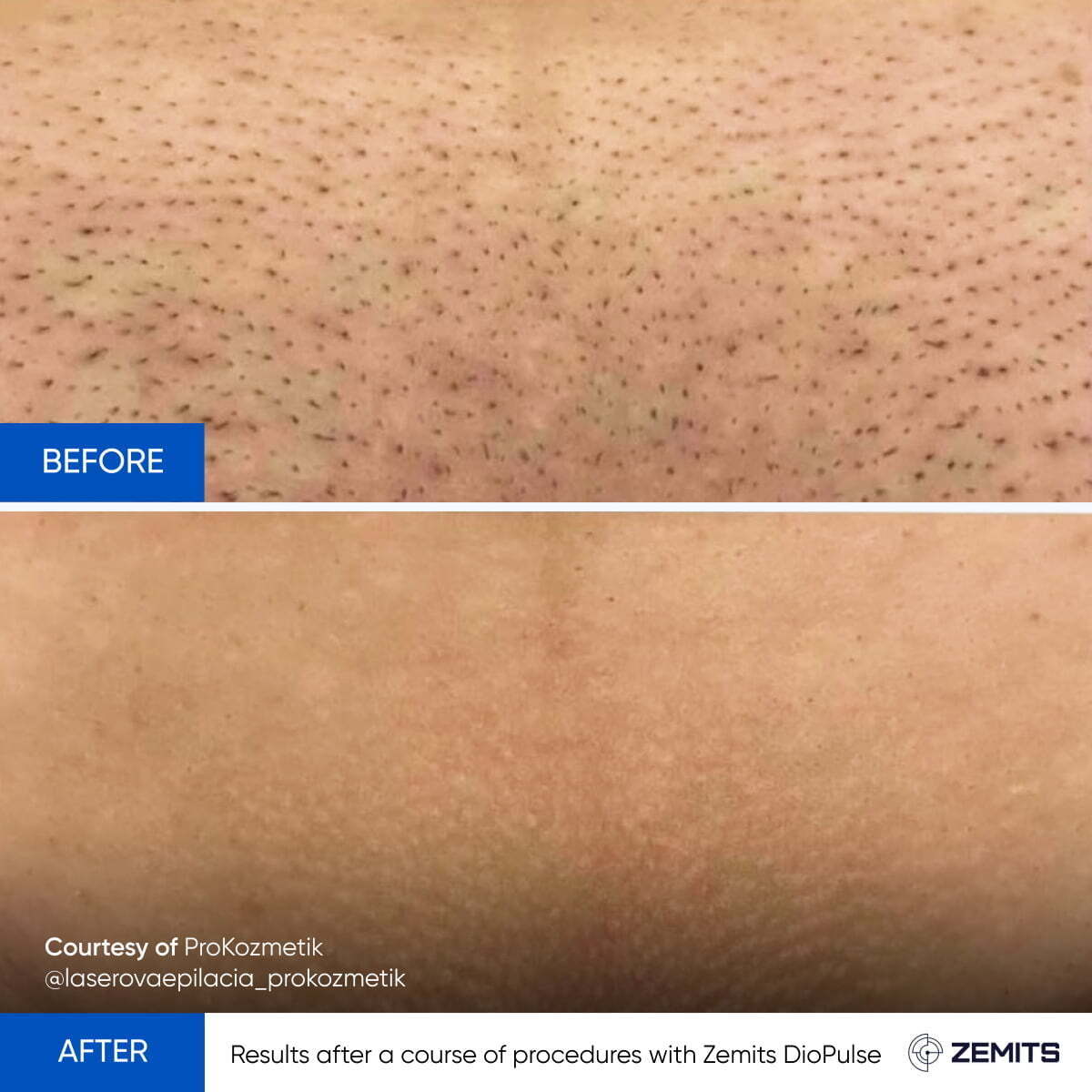 Zemits DioPulse Triple Wavelength Laser for Hair Rremoval 755, 808