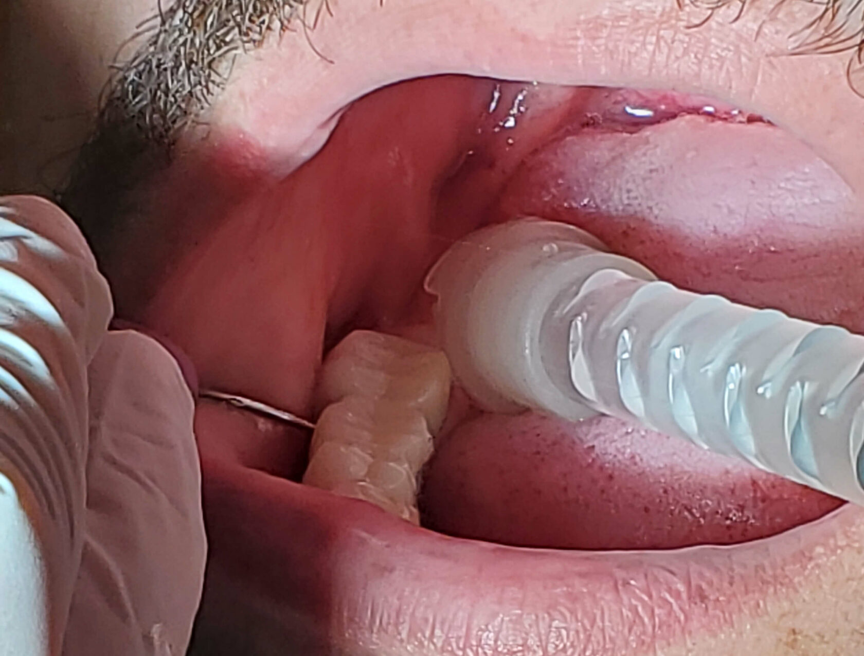 Biopolymer Dental Instrument