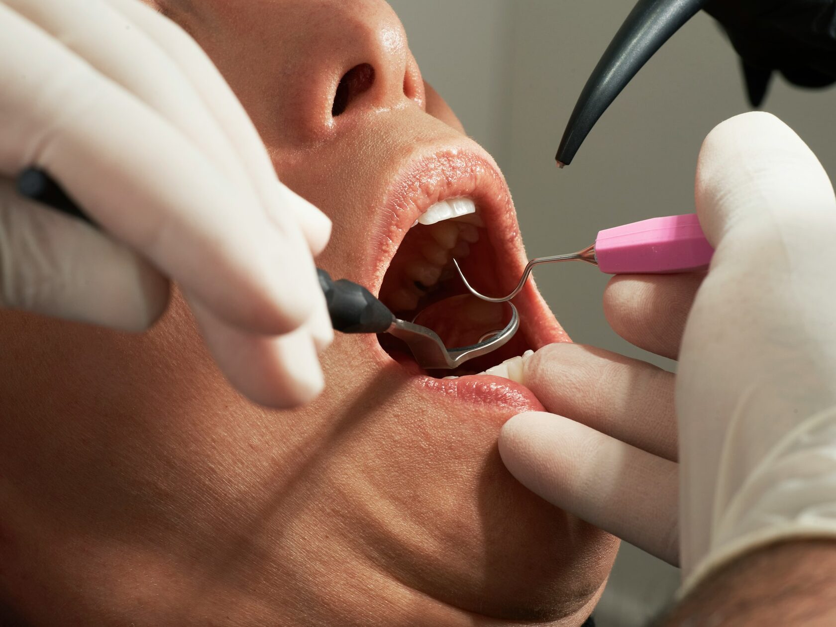 Profesionali burnos higiena: ultragarsinis valymas ir Air-flow