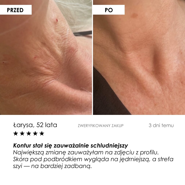 Przed i po: Łarysa, 52 lata — opinia klientki
