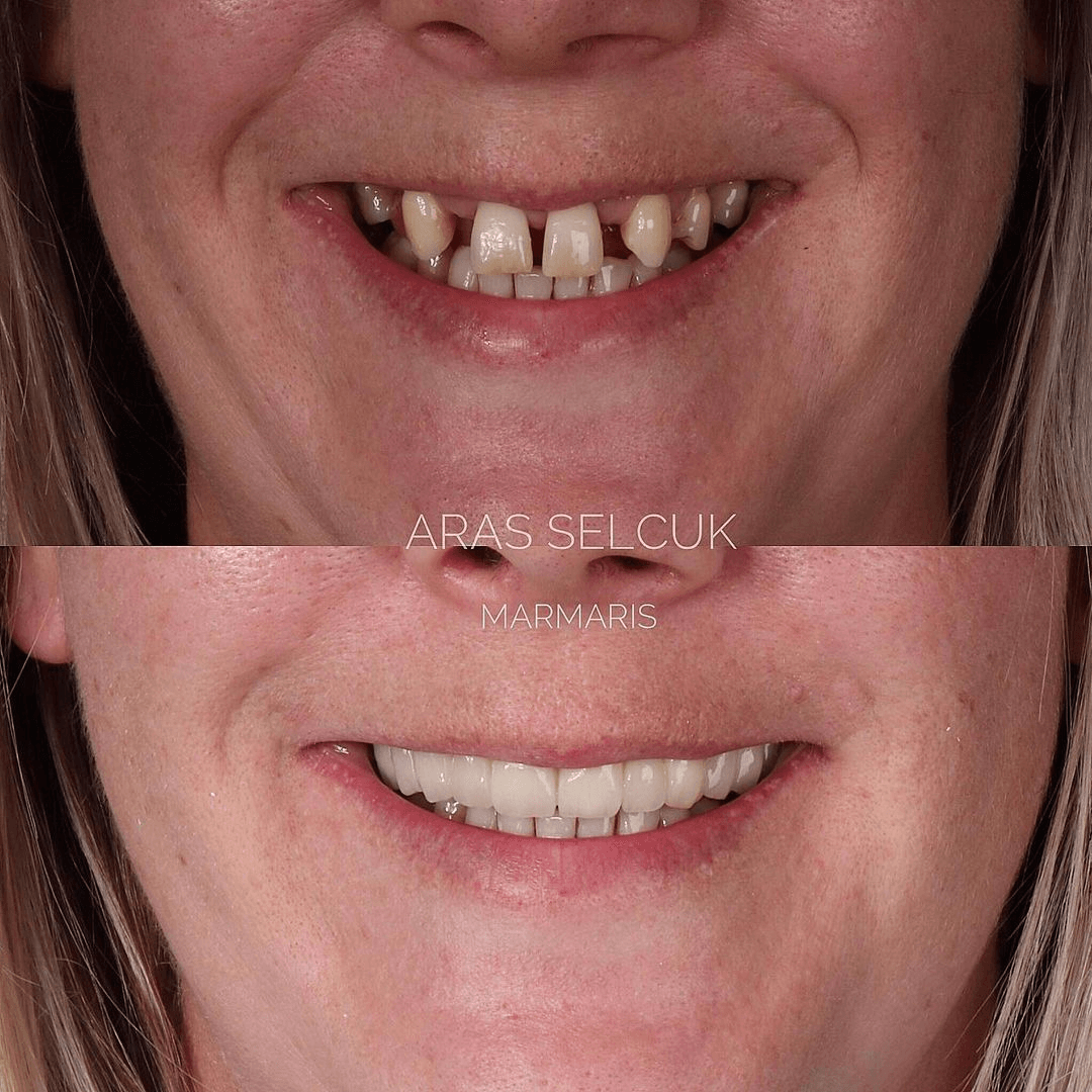 Quality dental implants turkey