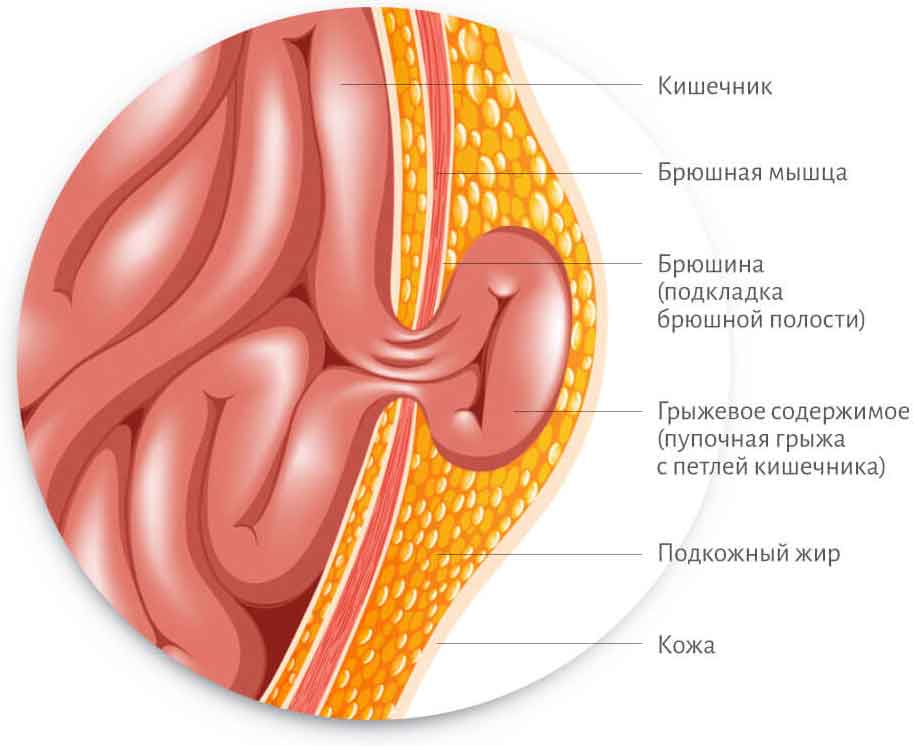 Чем опасна паховая грыжа?