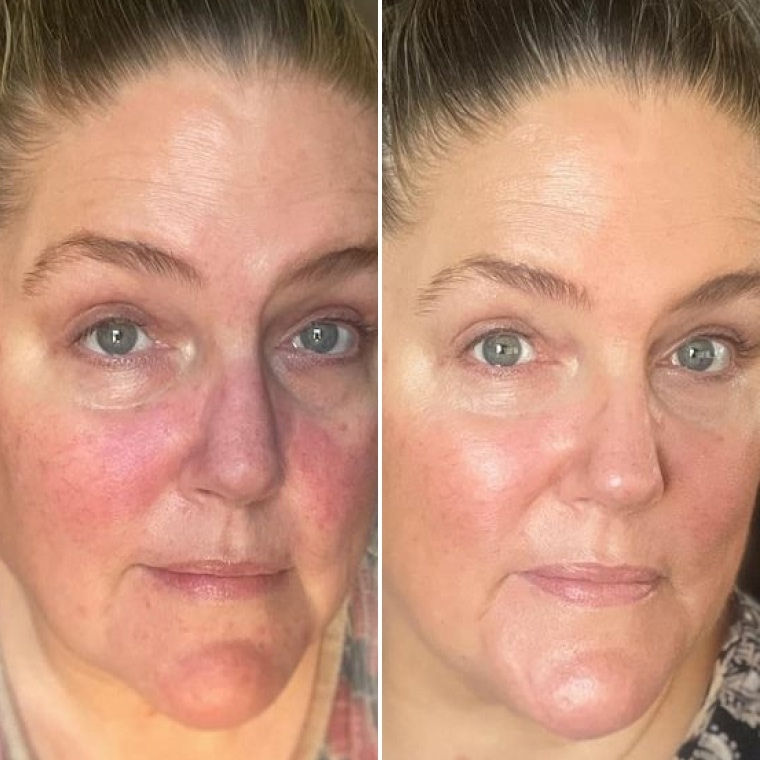 Лариса — до і після використання Ceramide Complex+