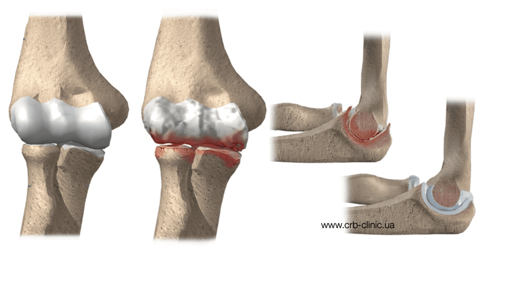 Боль в локтях. Лечение в клинике ортопедии CRB clinic