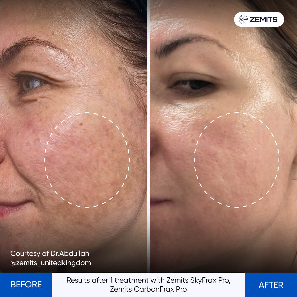 Zemits SkyFrax Pro Fractional Radiofrequency Microneedling