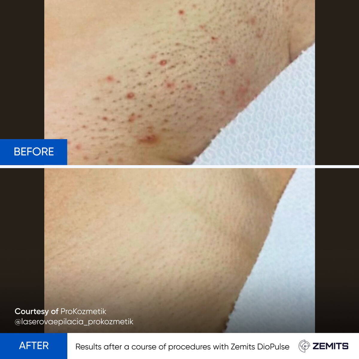 Zemits DioPulse Triple Wavelength Laser for Hair Rremoval 755, 808