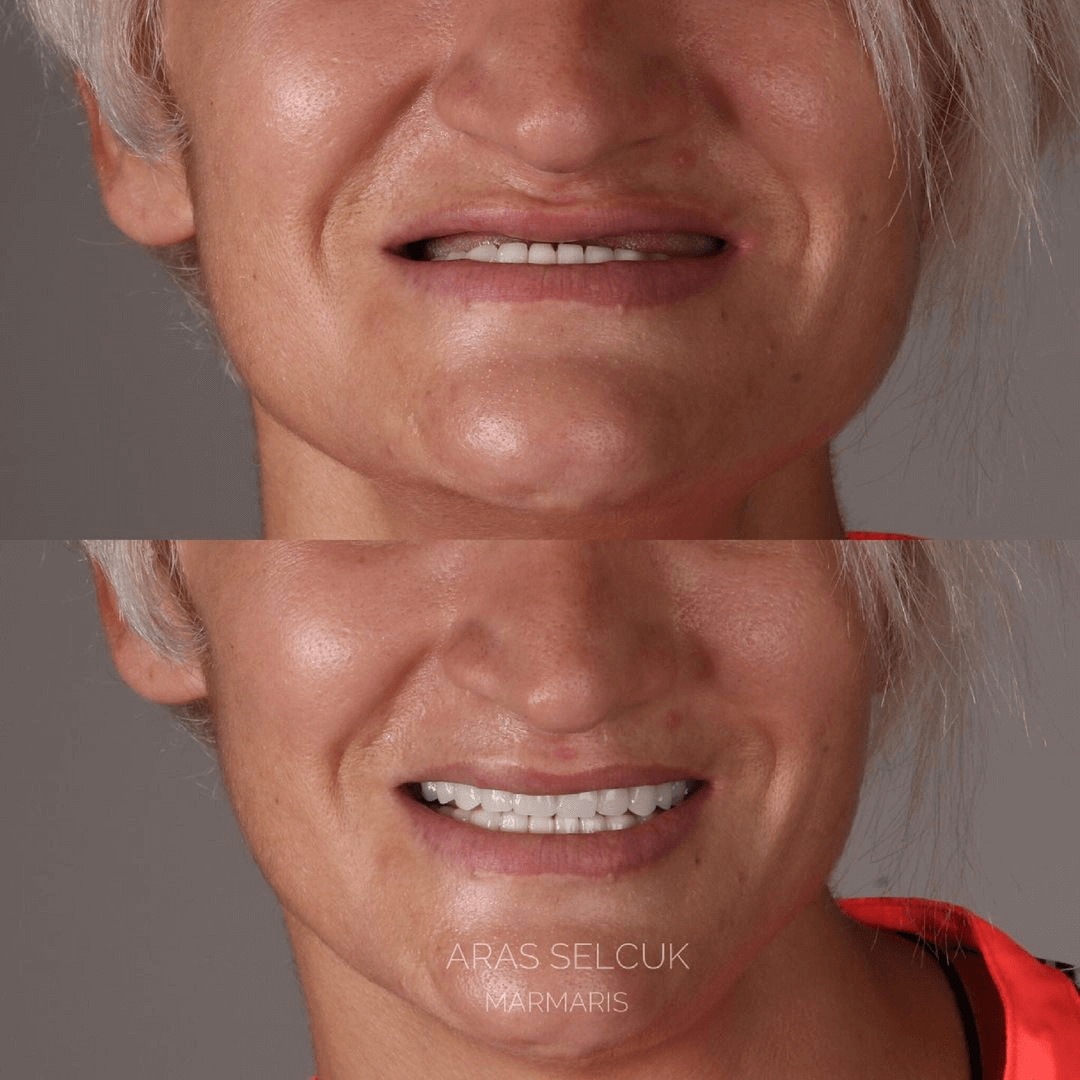 implant denture in Marmaris