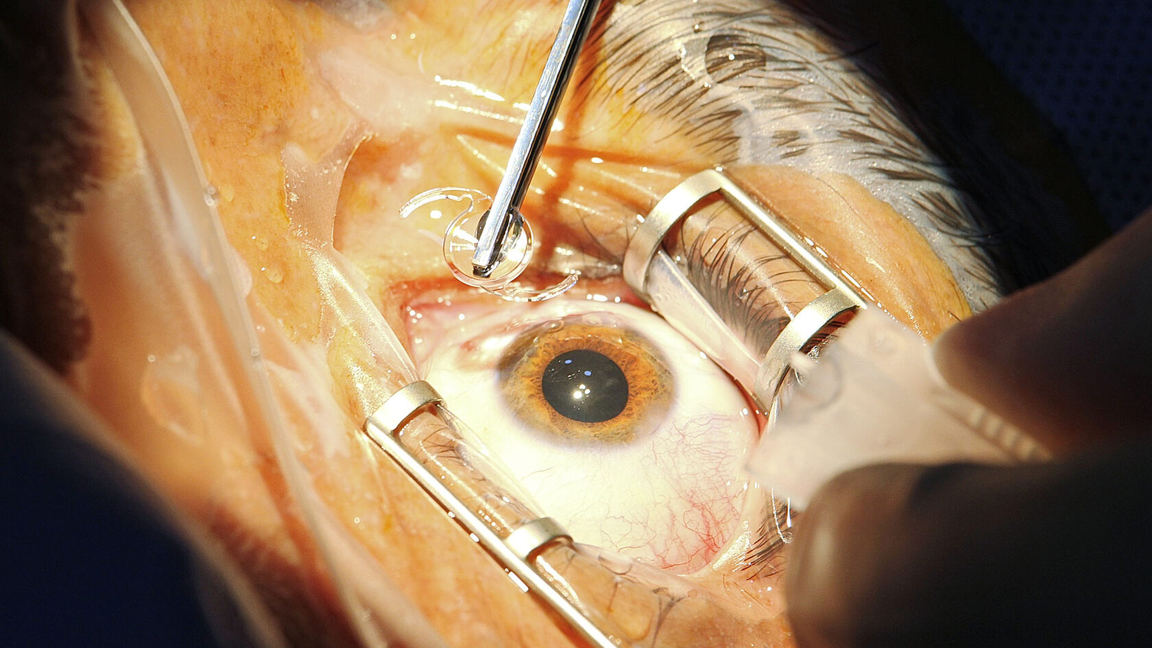 Multifocal Trifocal IOL