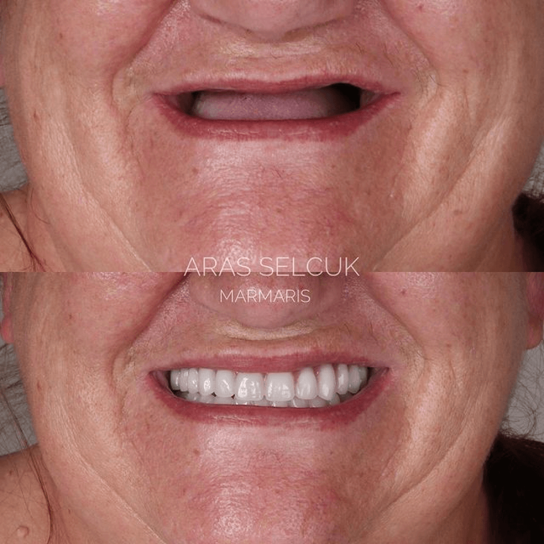 implant denture 