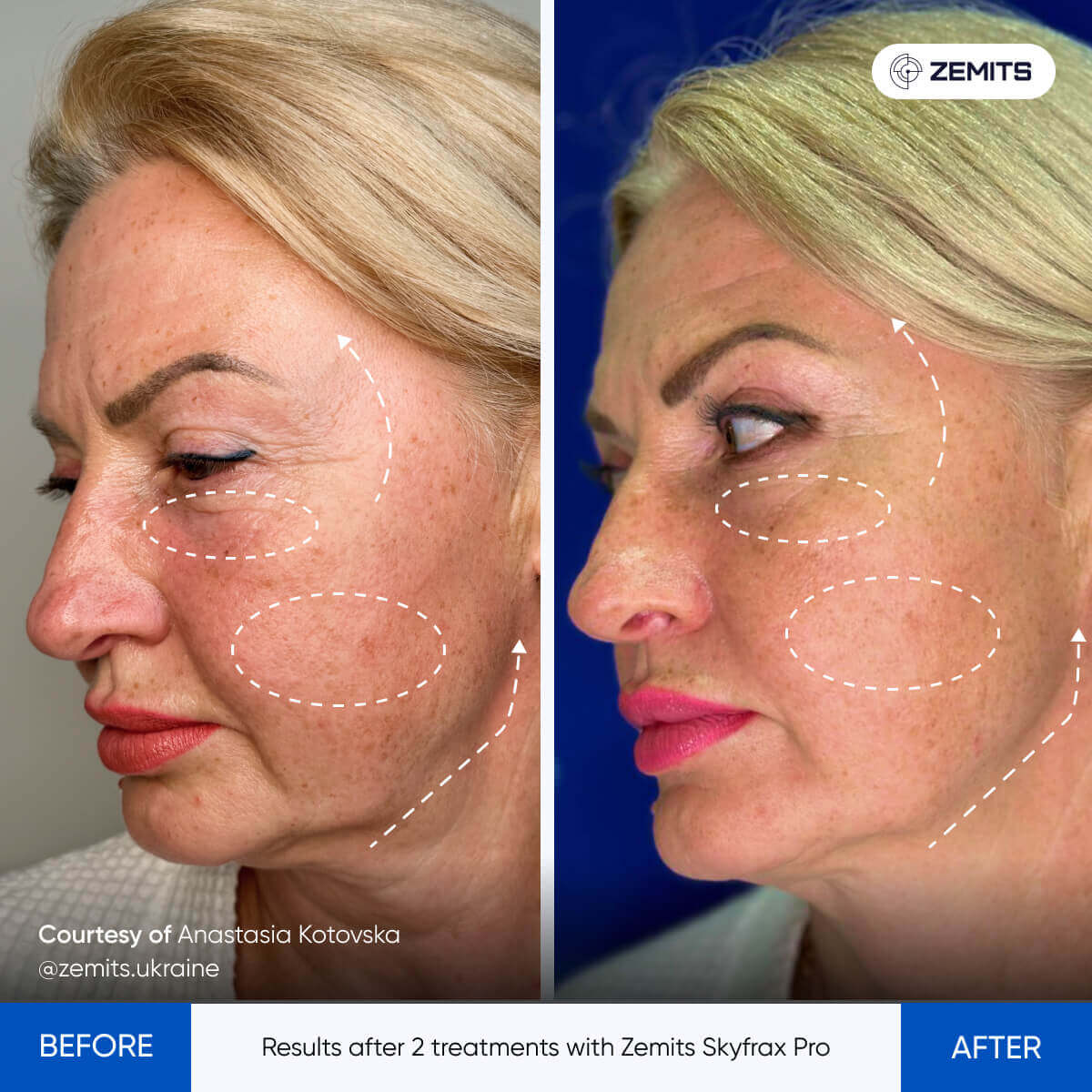 Zemits SkyFrax Pro Fractional Radiofrequency Microneedling