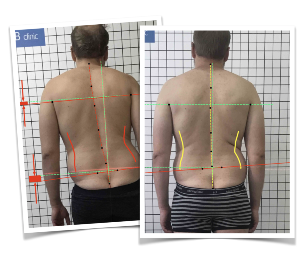 Ишиас. Воспаление седалищного нерва. Лечение в клинике ортопедии CRB clinic