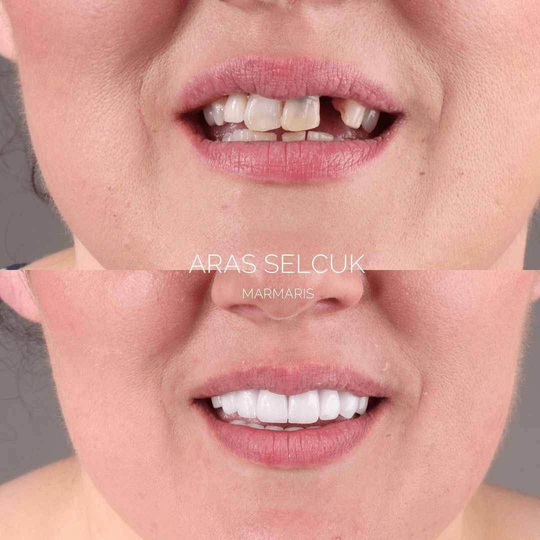 Laminate veneers in Turkey