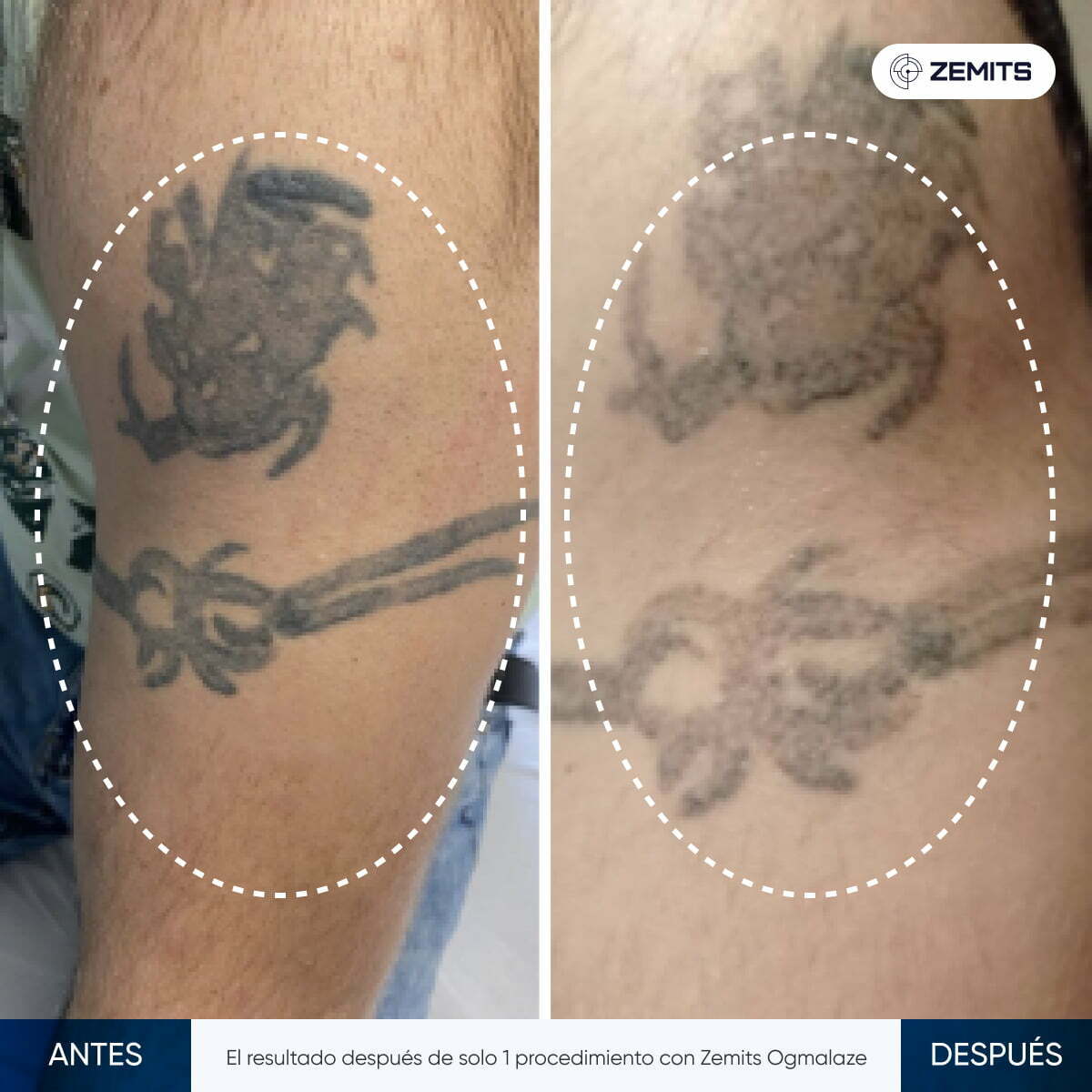 Tatuaje Despues De La Primera Sesion De Laser Axilas Despues De La