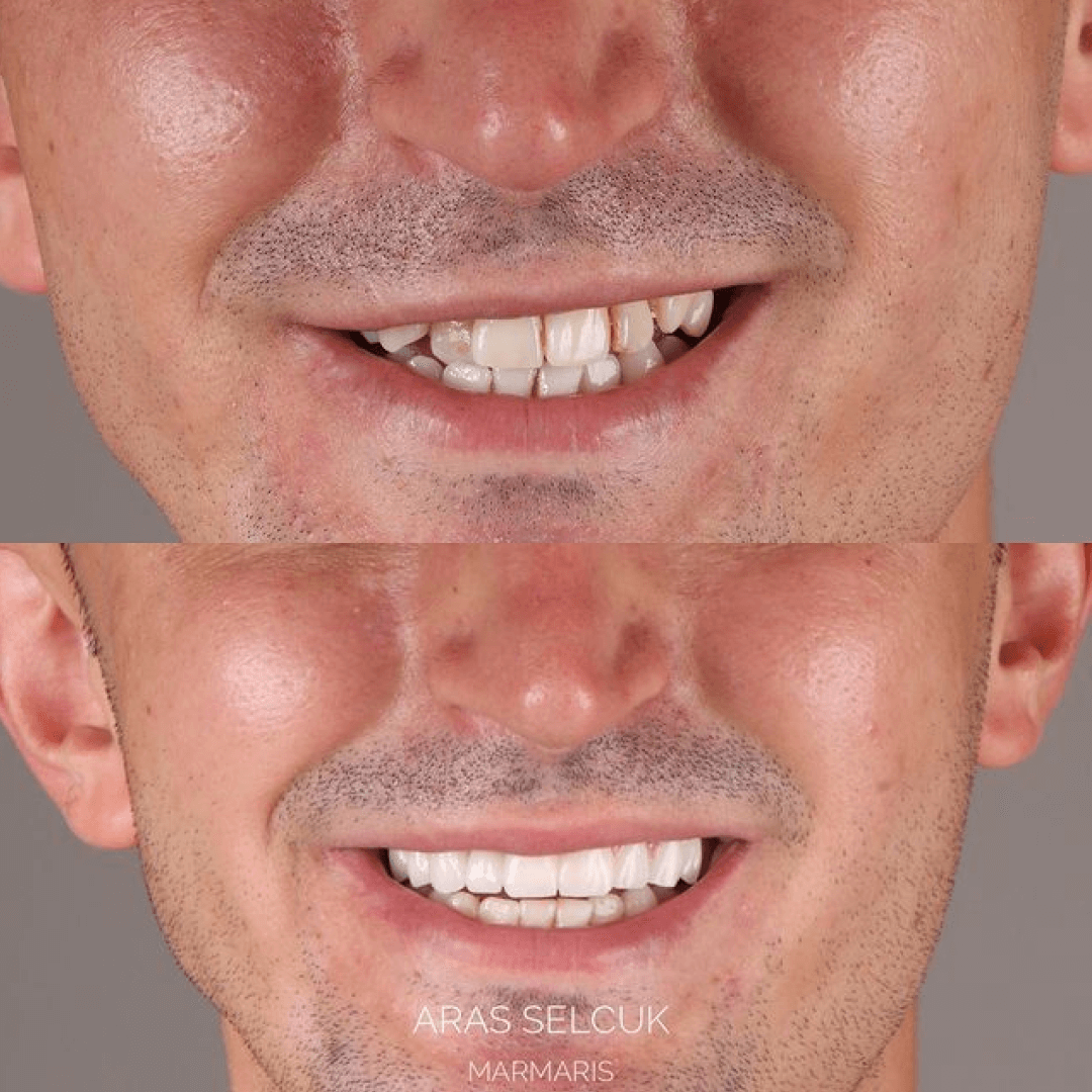 Smile makeover in Turkey