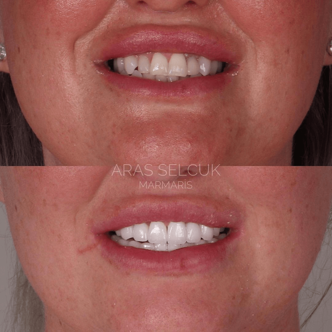 dental implants and porcelain crowns