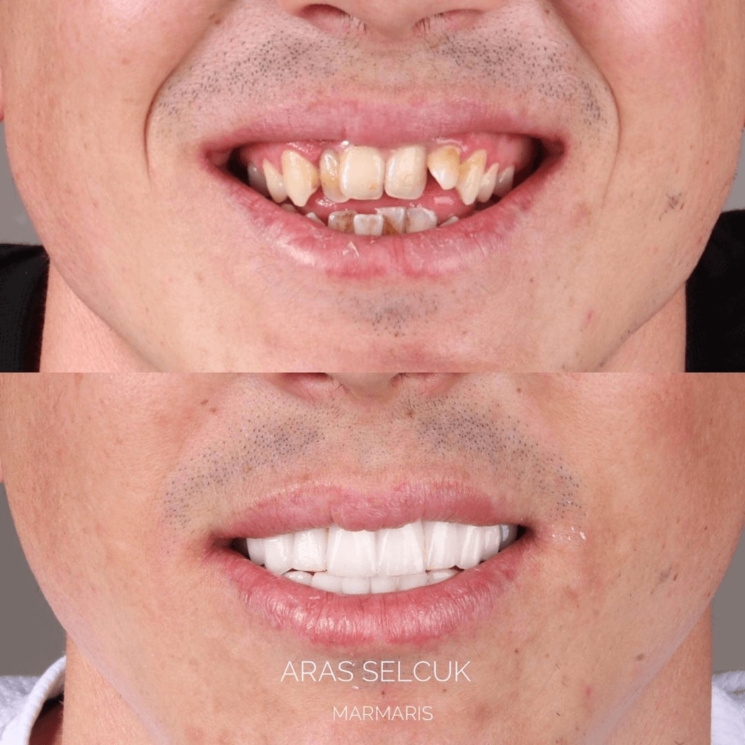 Laminate veneers in Marmaris