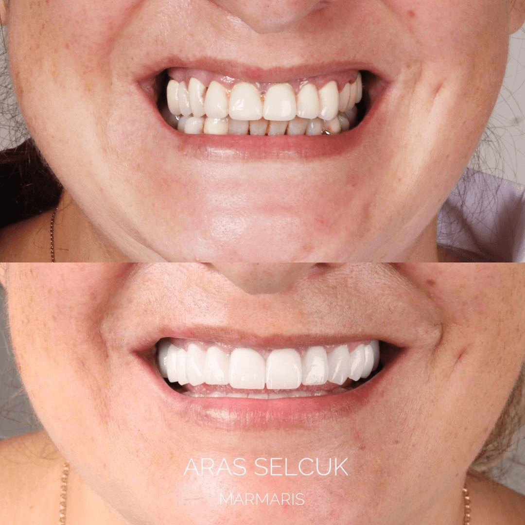 Zirconium crown Marmaris