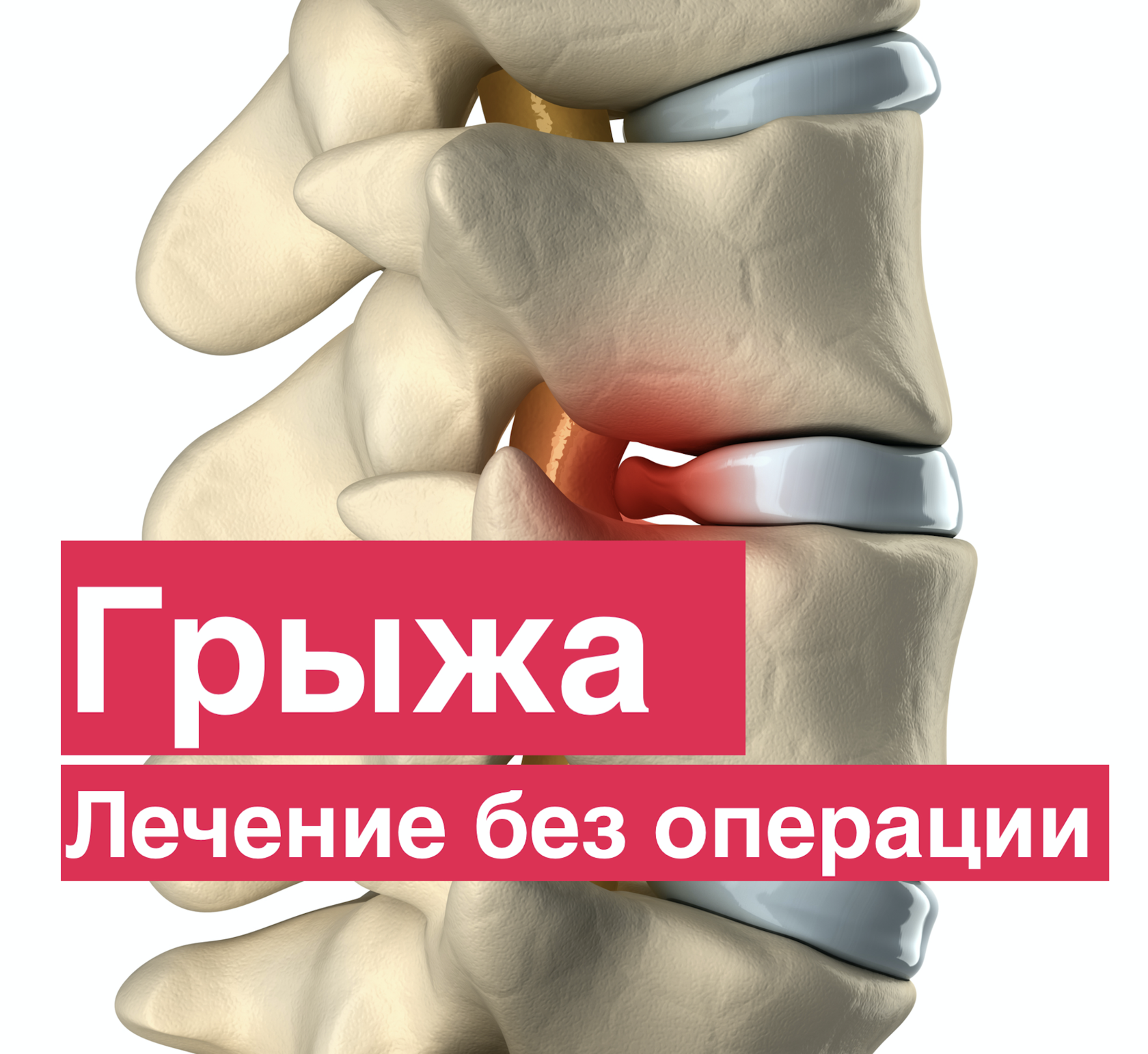 Грыжа позвоночника. Лечение без операции