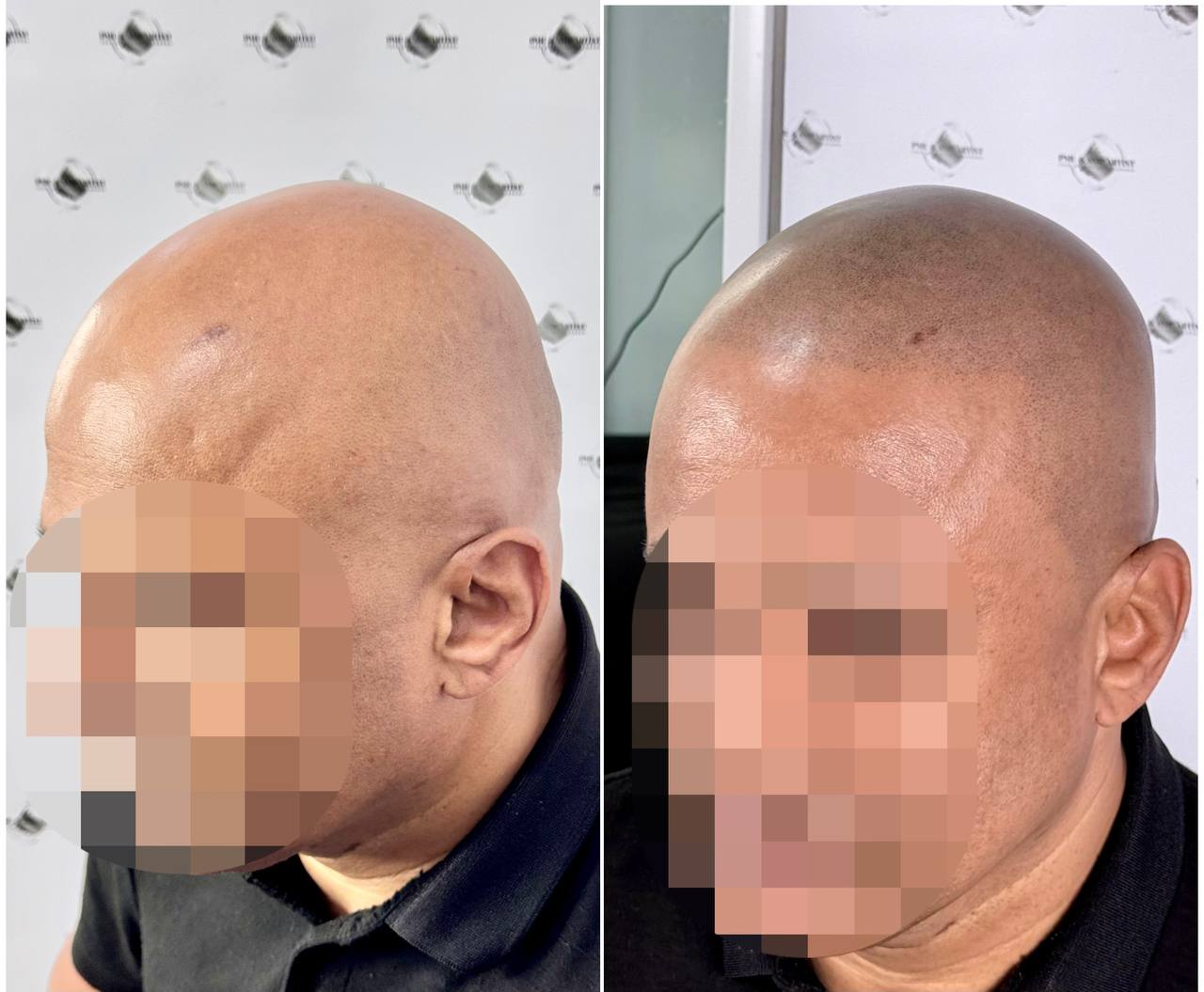 Before SMP treatment