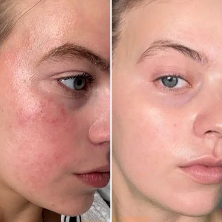 Валерія — до і після використання Ceramide Complex+
