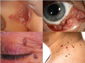 Turli qismlardagi papillomalar