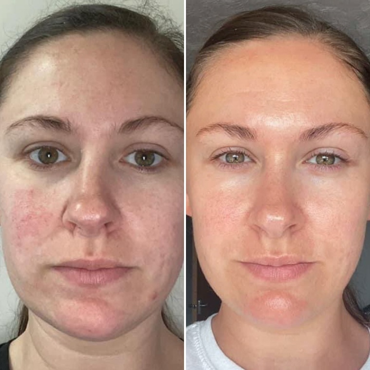Катерина — до і після використання Ceramide Complex+