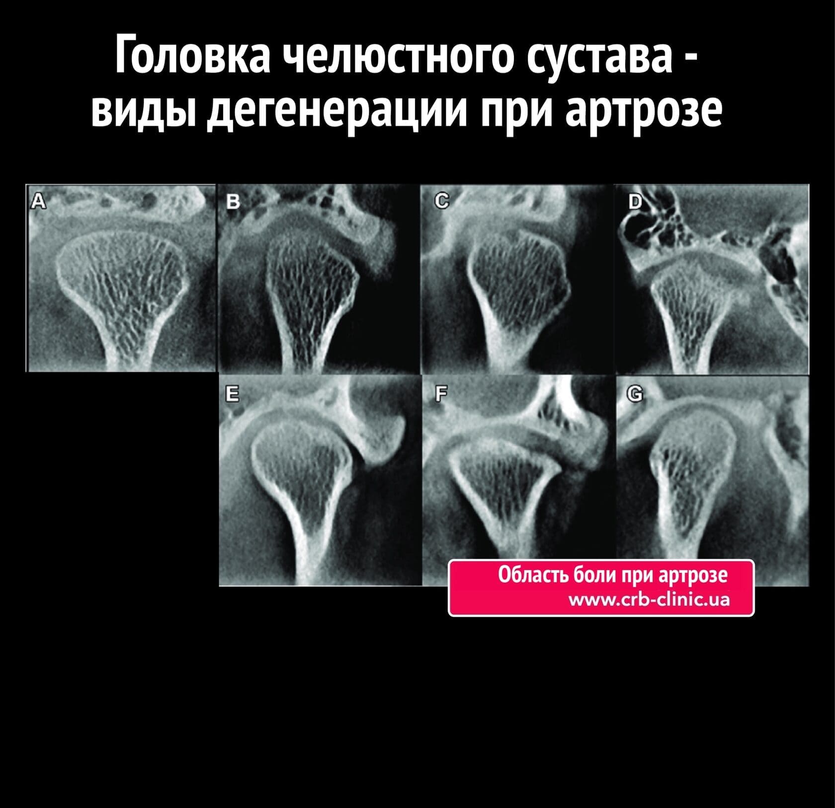 Боль в челюстном суставе. Лечение дисфункции ВНЧС