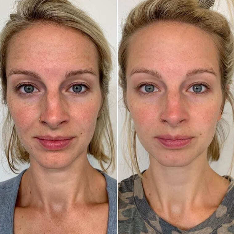 Przed i po stosowaniu serum ARGIRELINE® — Kateryna, 35 lat