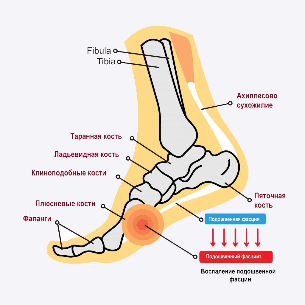 ТЕЙПИРОВАНИЕ ПРИ «ПЯТОЧНОЙ ШПОРЕ»