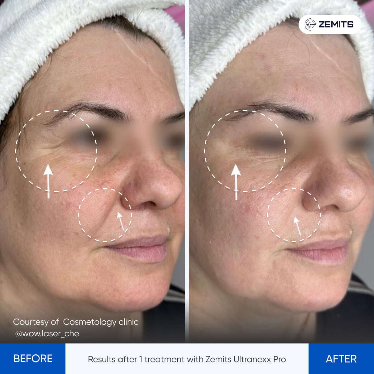 Zemits UltraNexx Pro HIFU 3D Smas lifting machine for skin tightening