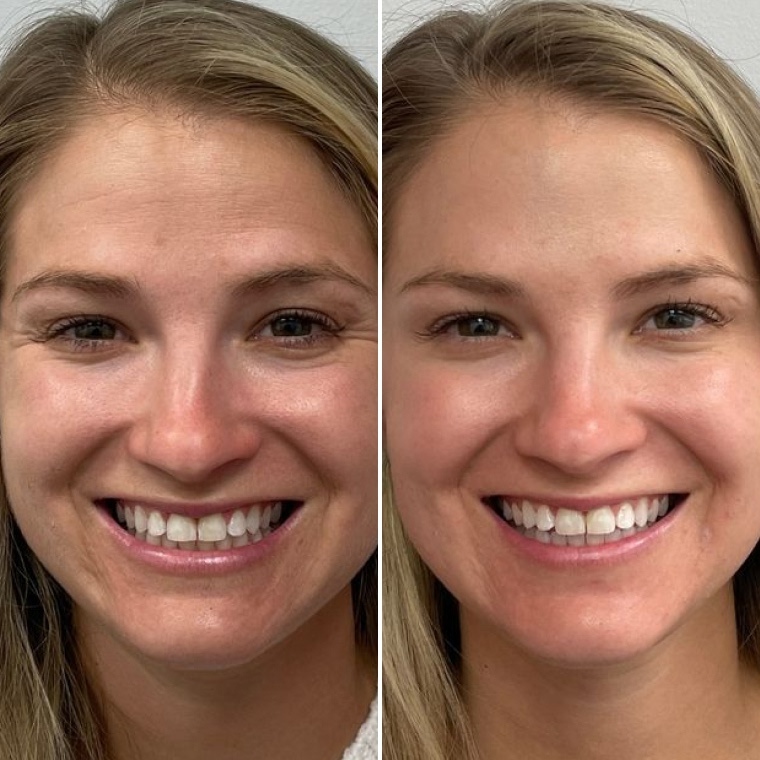 Przed i po stosowaniu serum ARGIRELINE® — Oksana, 42 lata