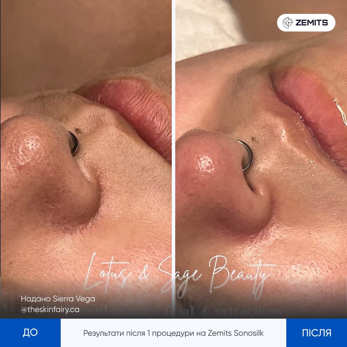 Набір косметики для ультразвукового чищення Pro - Замовити в