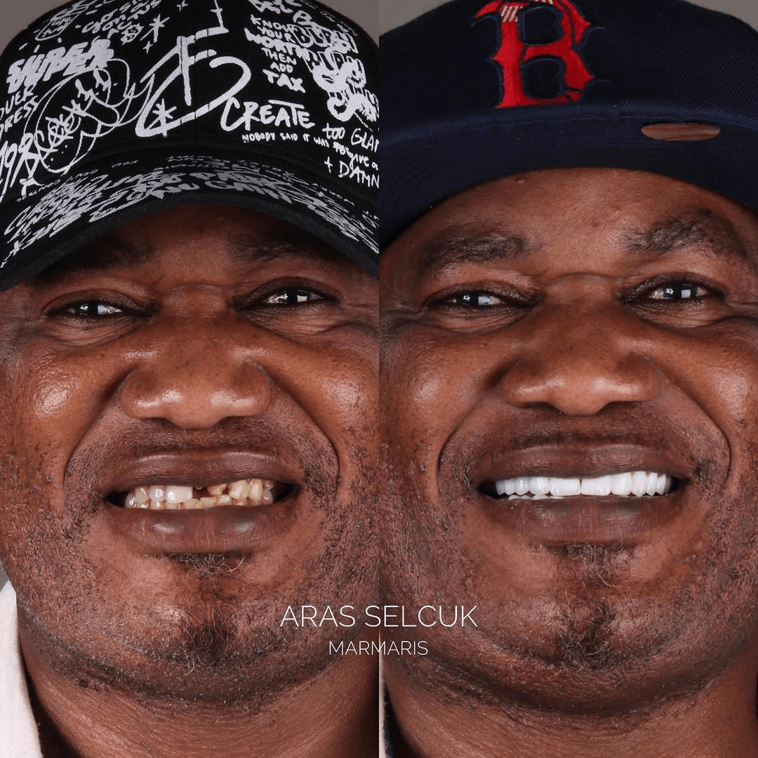 Laminate veneers Marmaris