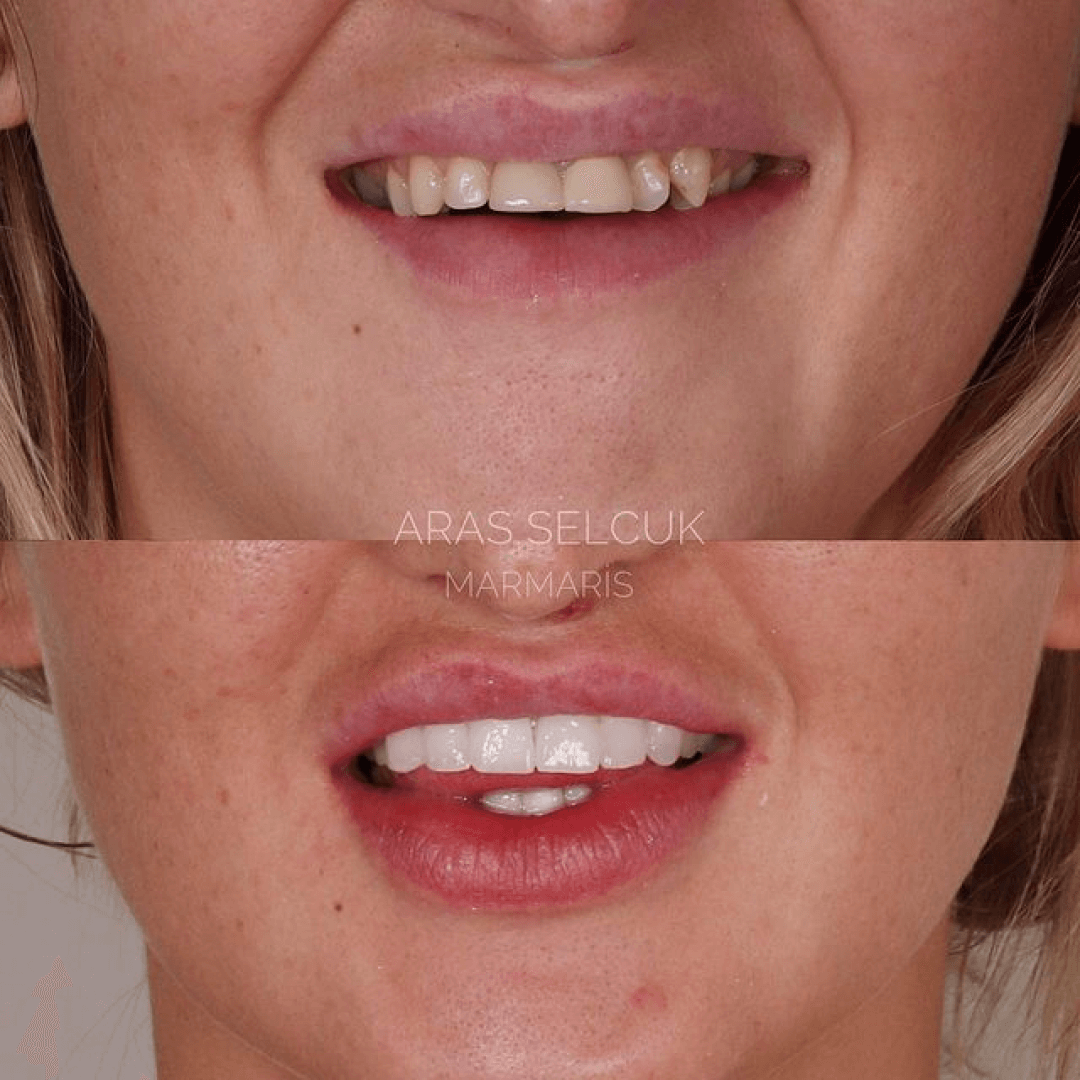 Zirconia crowns in Turkey