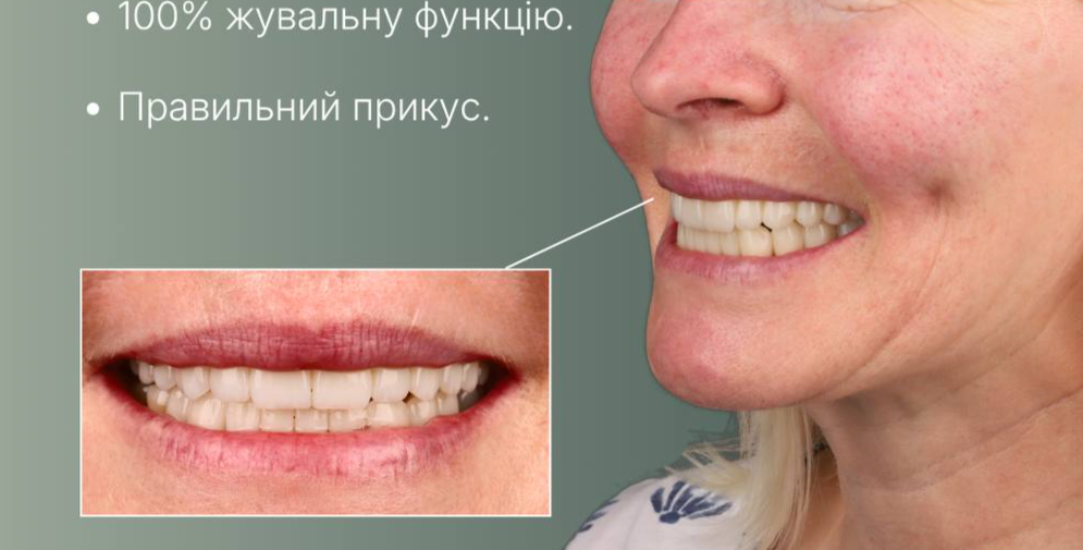 Керамічні вініри