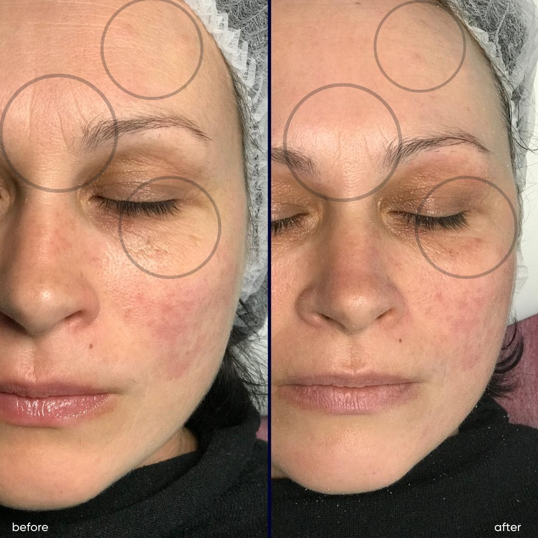 До_и_после_на_Zemits_Leon_Plus_Косметологический_комбайн_6_в_1