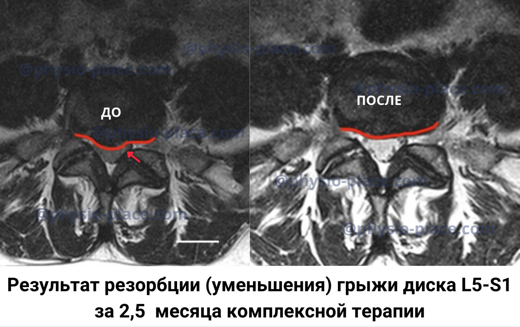 Лечение межпозвонковых грыж и протрузий | Центр физической терапии  PHYSIOPLACE