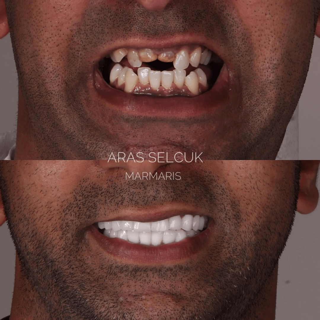 Tooth implants in Turkey