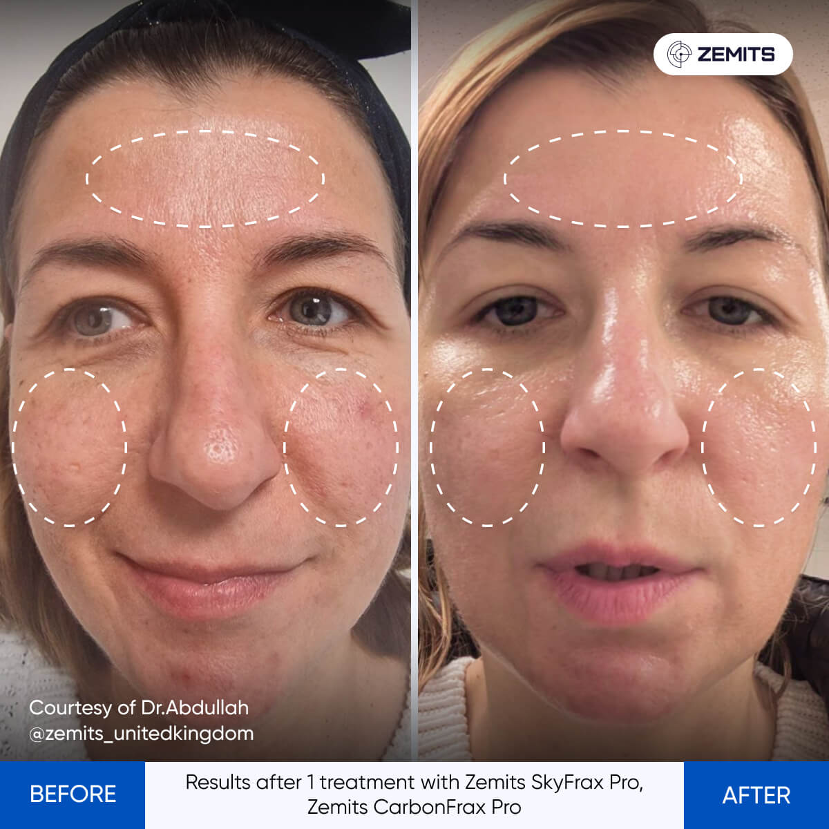 Zemits SkyFrax Pro Fractional Radiofrequency Microneedling