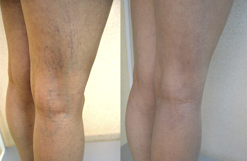 Endovenoz lazer