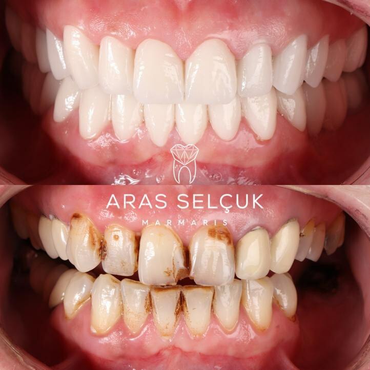 Best Dental Treatment in Turkey