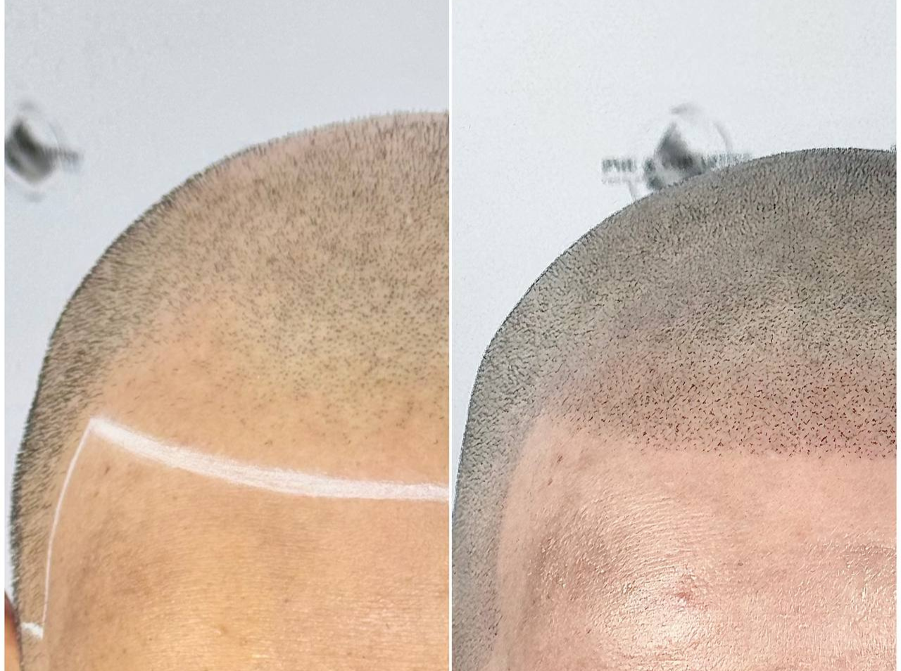 Before Hairline SMP
