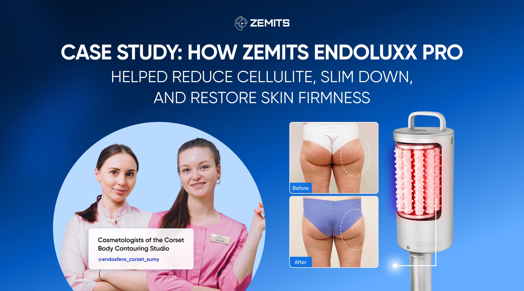 Case Study: How Zemits EndoLuxx Pro Helped Reduce Cellulite, Slim