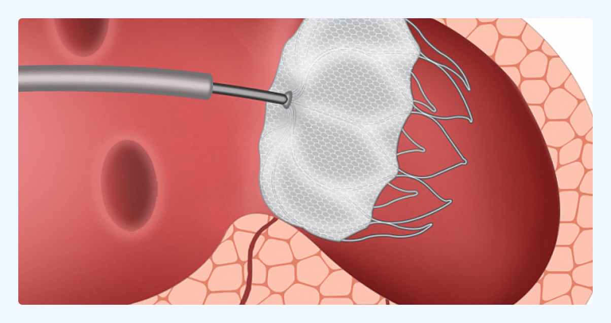 Окклюдер левого ушка. Закрытие дмпп окклюдером. Окклюдер ушка левого предсердия. Имплантация окклюдера. Окклюдер левого ушка.