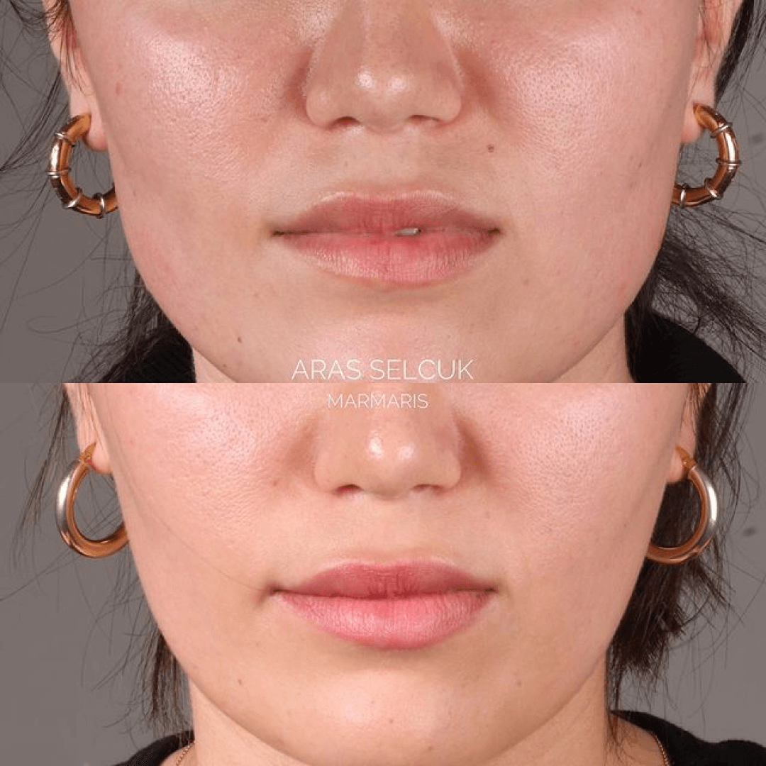 Botox injection Marmaris