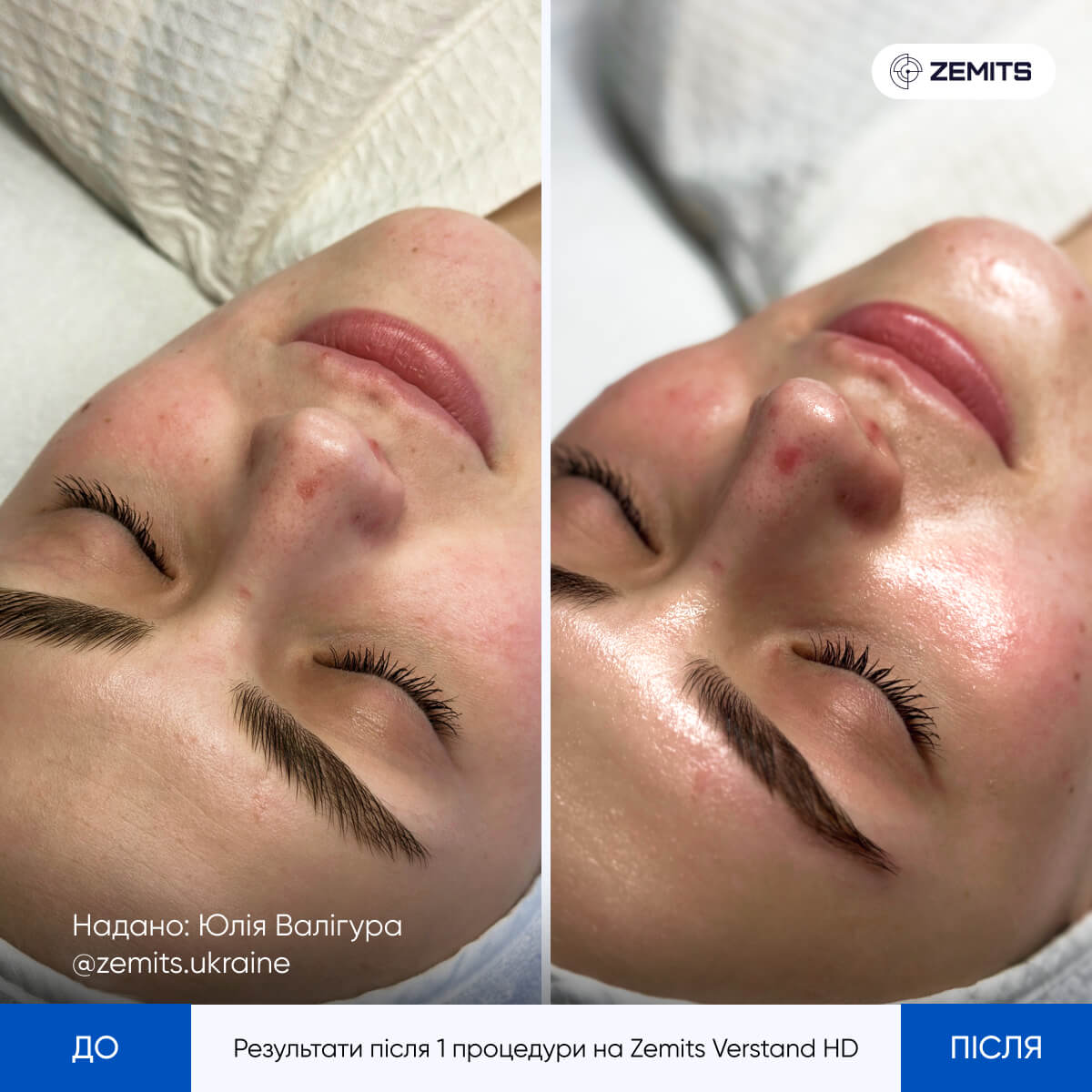 Zemits Verstand HD Pro Комбайн 8 в 1 з технологією HydroDiamond